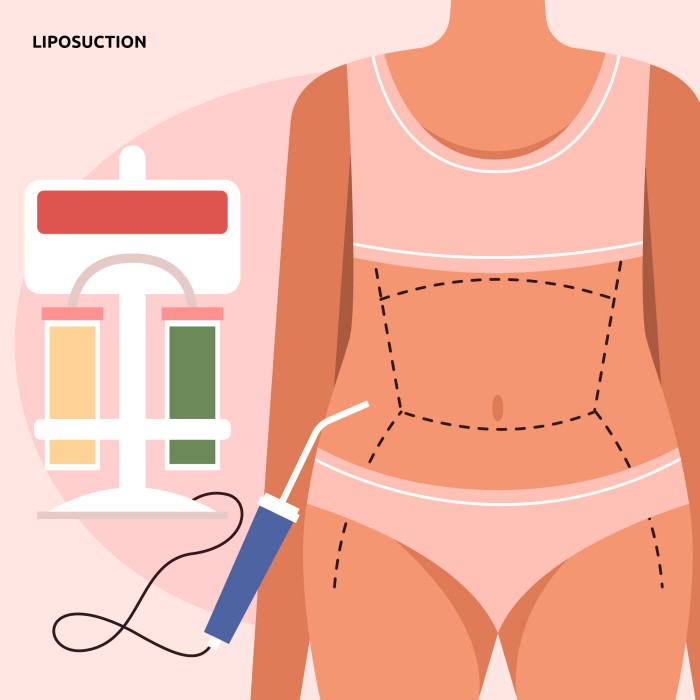 Liposakşın (Yağ Aldırma): Her Şeyin Detayları 