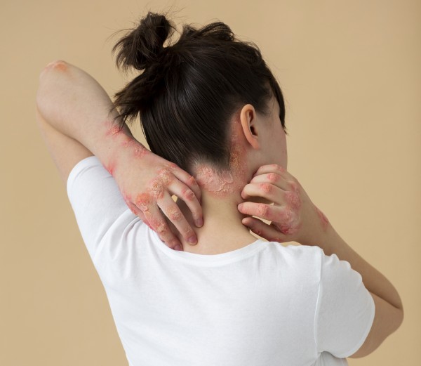 Egzama (Dermatit) Nedir? Belirtileri, Nedenleri ve Tedavi Yöntemleri 