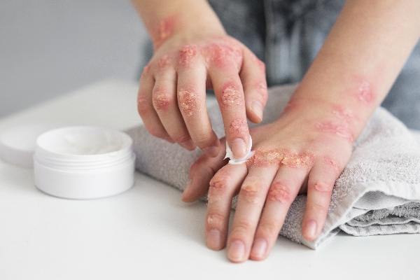 Sedef Hastalığı (Psoriasis) Hakkında Her Şey 
