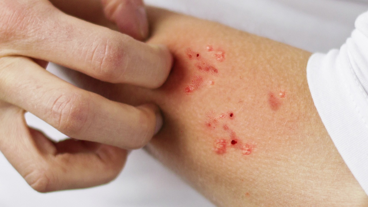 scabies uyuz hastaligi nedir tedavisi nasildir hastanem yanimda