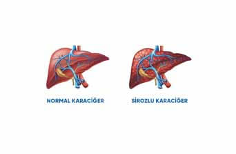 SİROZ HASTALIĞININ BELİRTİLERİ NELERDİR?