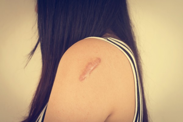 Keloid Nedir? Belirtileri, Nedenleri ve Tedavi Yöntemleri 